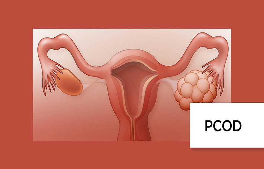 PCOD and PCOS